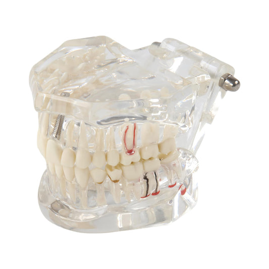 Transparent Dental Disease Teeth Model with Removable Teeth Dental Implant Typodont for Pathological Demonstration Dentist Patient Education Teaching