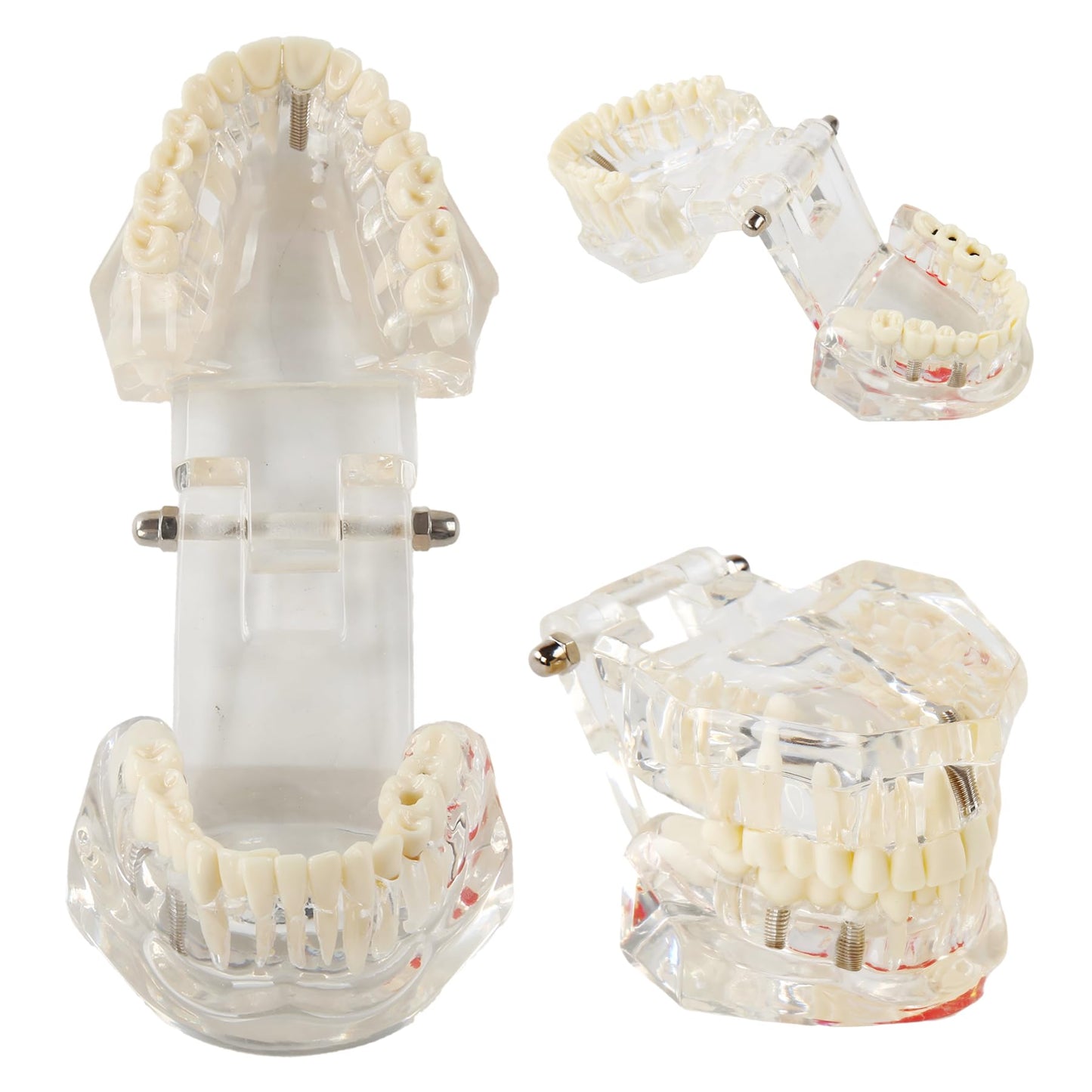 Transparent Dental Disease Teeth Model with Removable Teeth Dental Implant Typodont for Pathological Demonstration Dentist Patient Education Teaching