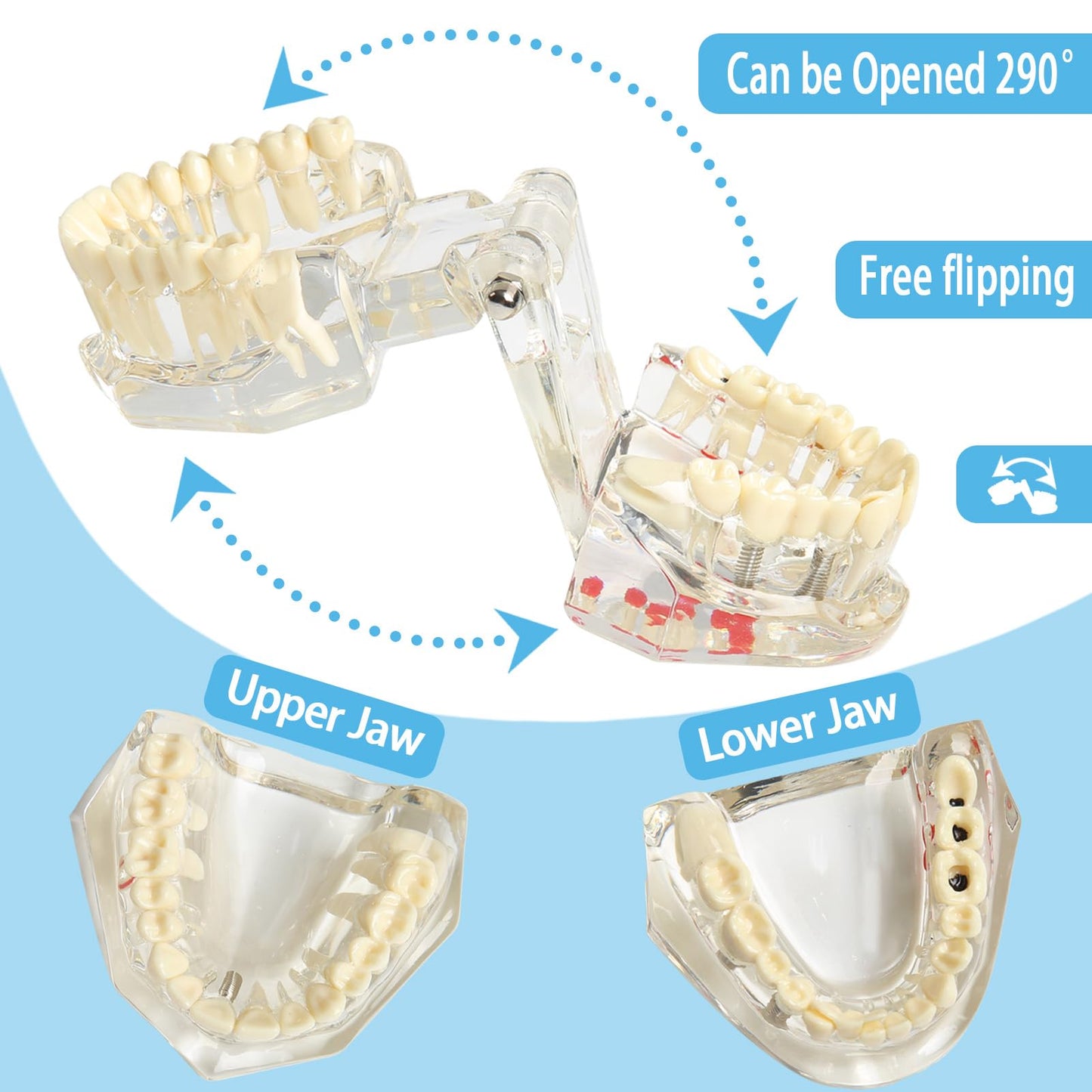 Transparent Dental Disease Teeth Model with Removable Teeth Dental Implant Typodont for Pathological Demonstration Dentist Patient Education Teaching