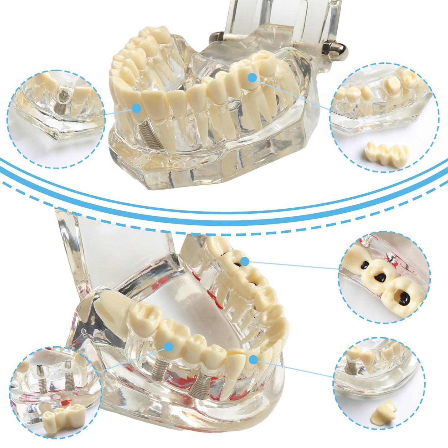 Transparent Dental Disease Teeth Model with Removable Teeth Dental Implant Typodont for Pathological Demonstration Dentist Patient Education Teaching